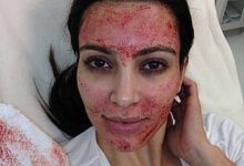 أجرت كيم كارداشيان عملية تجميل مصاصي الدماء لتنعيم الخطوط على وجهها